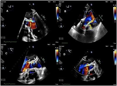 Intravascular lithotripsy (IVL) enabled the percutaneous closure of a severely calcified paravalvular leak regurgitation following implantation of a self-expandable transcatheter aortic valve: a case report